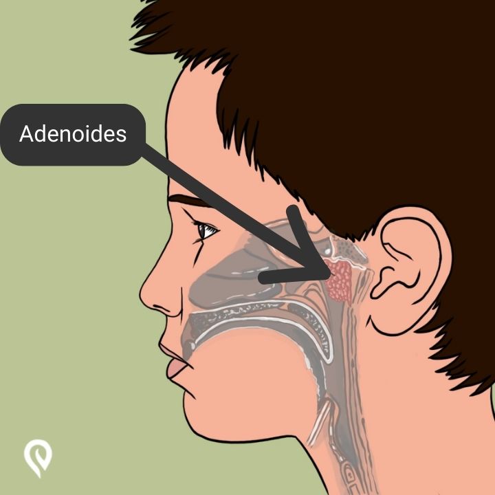 Imagem indicando a localização das adenoides - Carne esponjosa no nariz