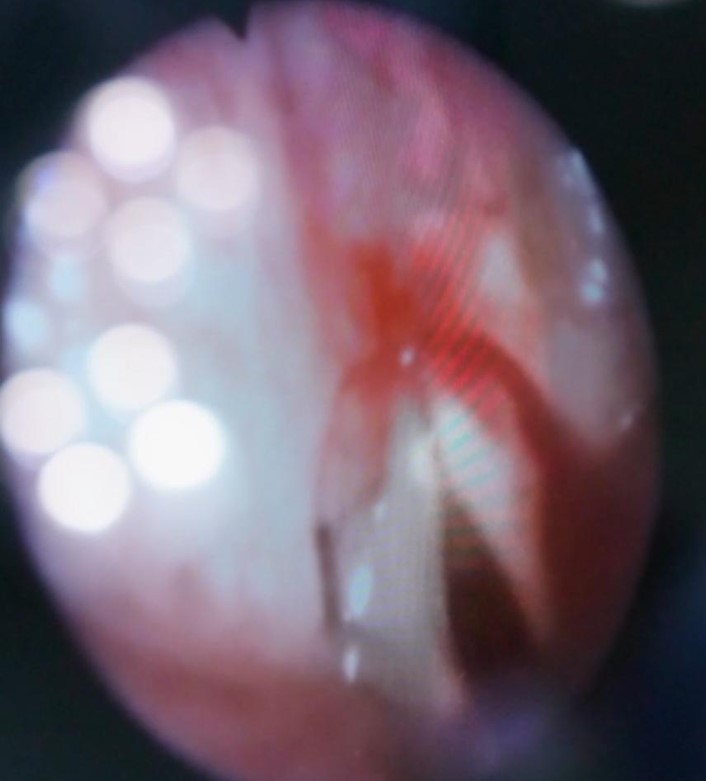 Monitoramento endoscópico durante a condroplastia laríngea.